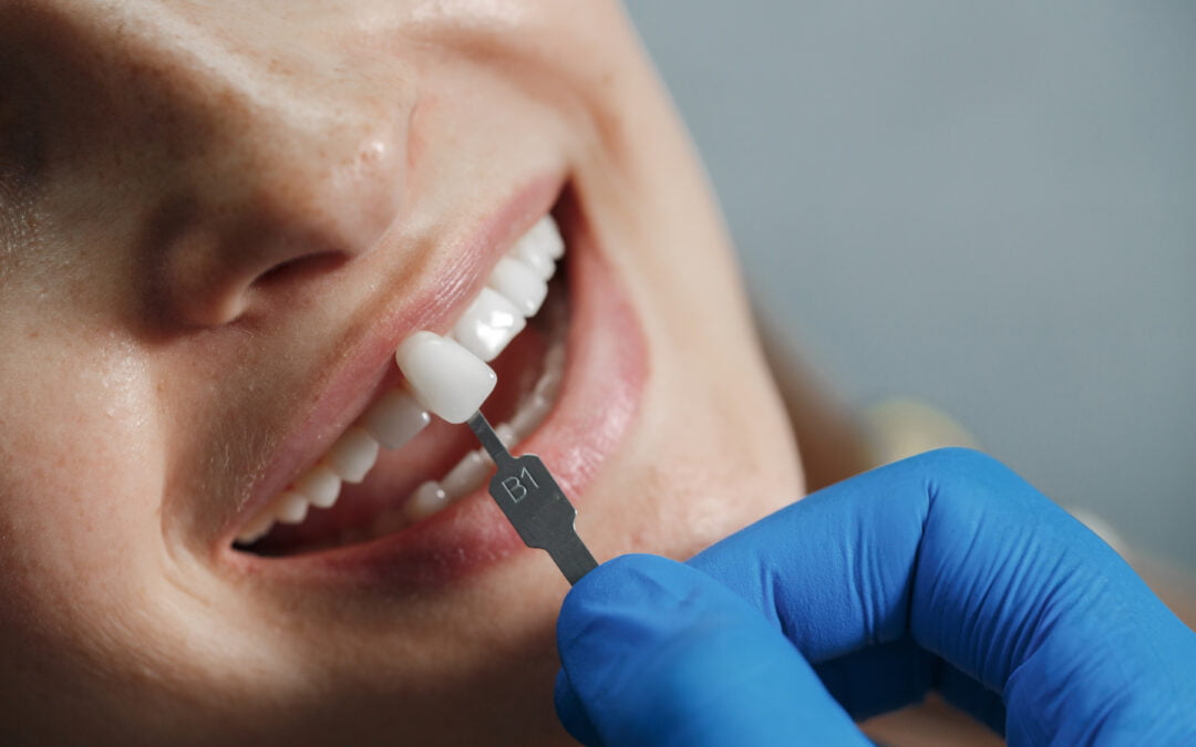 Lentes de Contato e Facetas Dentárias: Indicações Adequadas